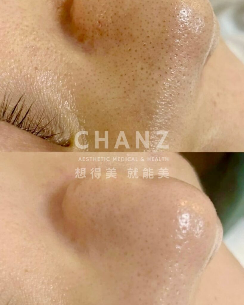 chanz