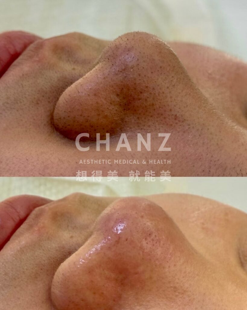 chanz