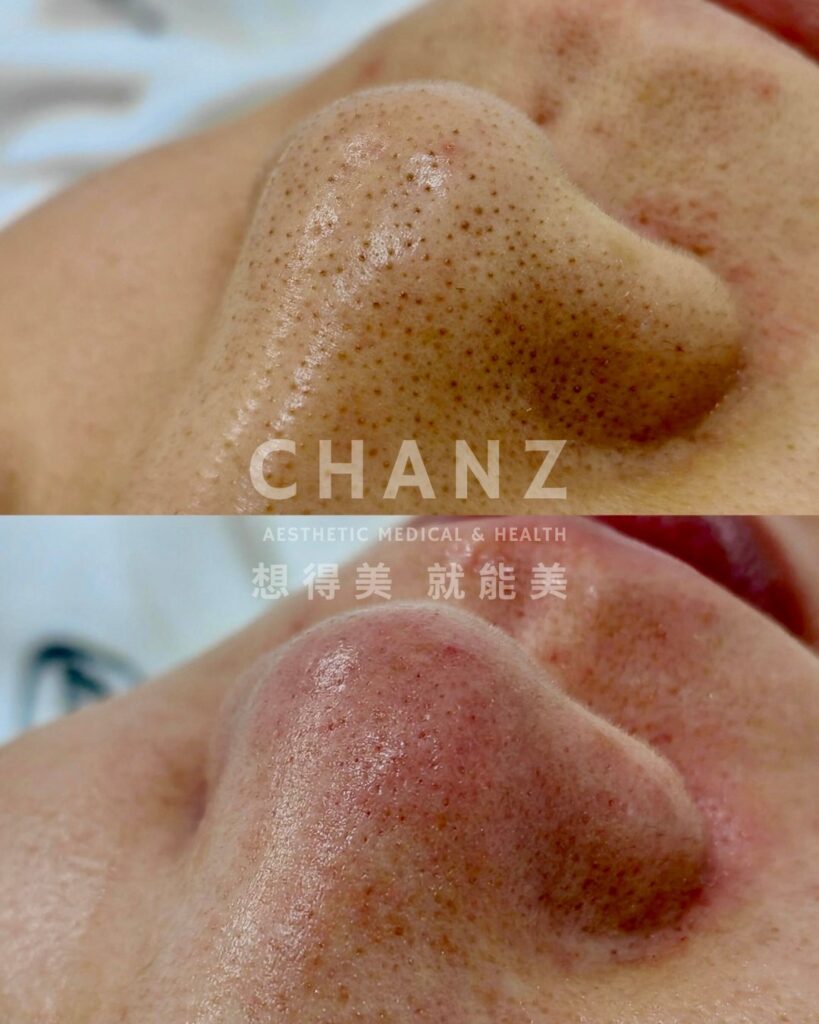 chanz